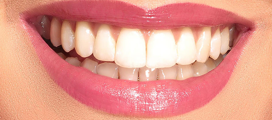Yaprak Porselen (Lamina) nedir? 1