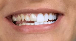 Yaprak Porselen (Lamina) nedir? 3
