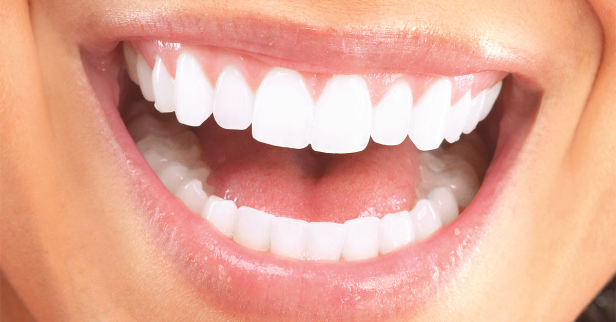 Yaprak Porselen (Lamina) nedir? 4