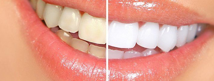 Yaprak Porselen (Lamina) nedir? 5