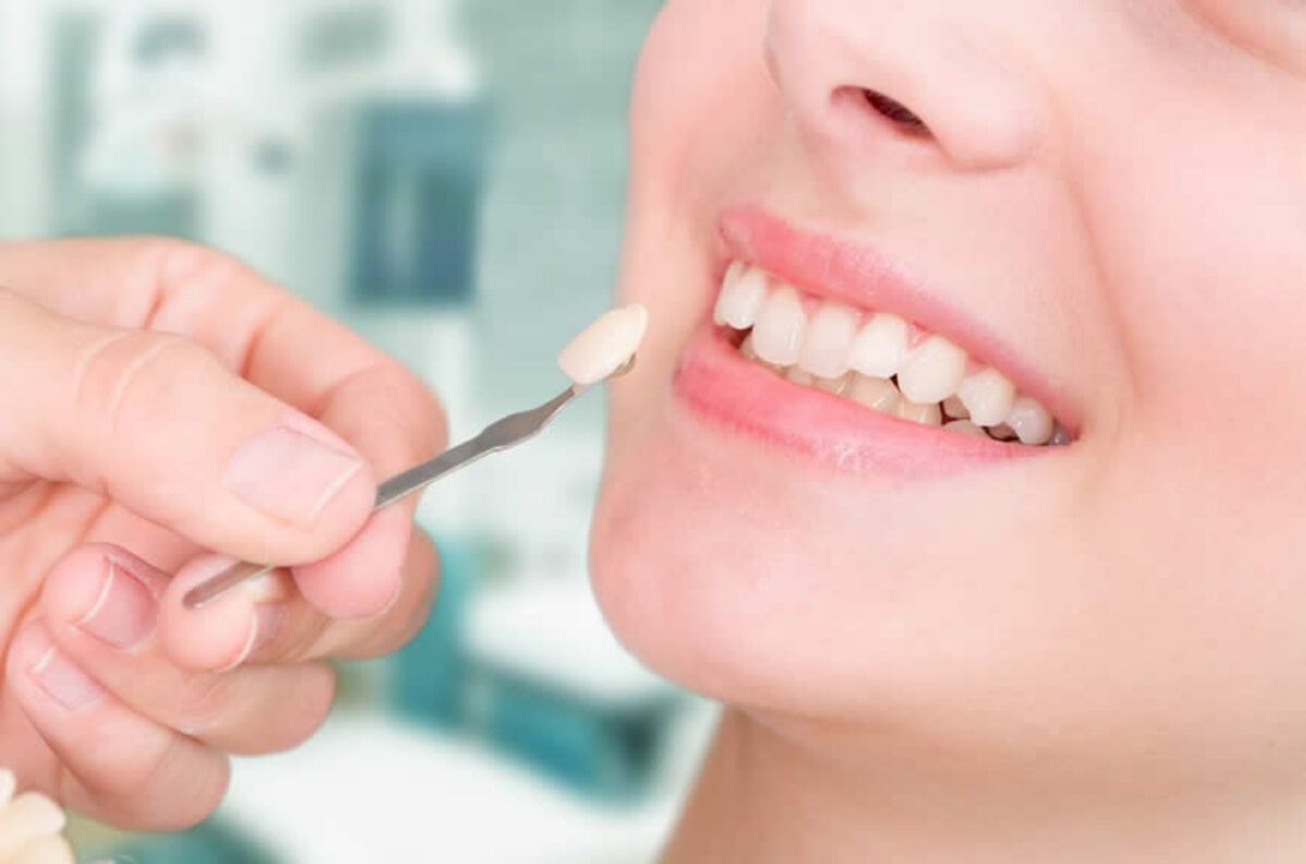 Yaprak Porselen (Lamina) nedir? 9