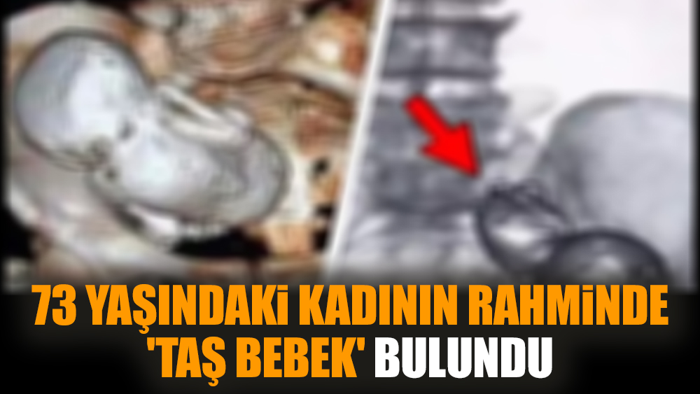 73 yaşındaki kadının rahminde 'taş bebek' bulundu