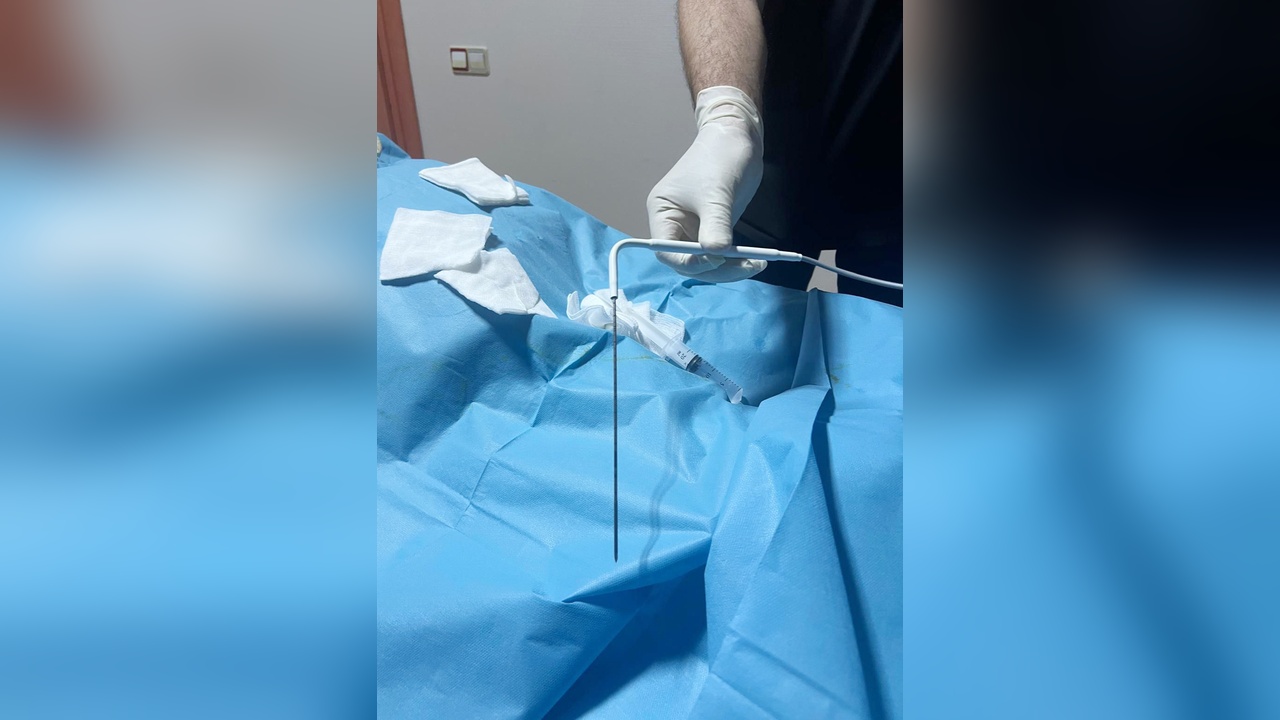 Ameliyat Edilemeyen Tümörler Yeni Yöntemle Dondurularak Yok Ediliyor