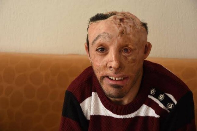 Bu gencin beyin ve estetik ameliyatlarını yapacak doktor bulunamadı